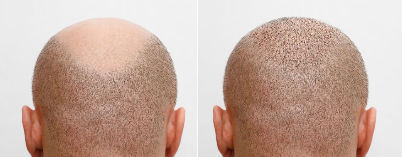 Hair Transplant UK – Why Choose Westminster Medical Group